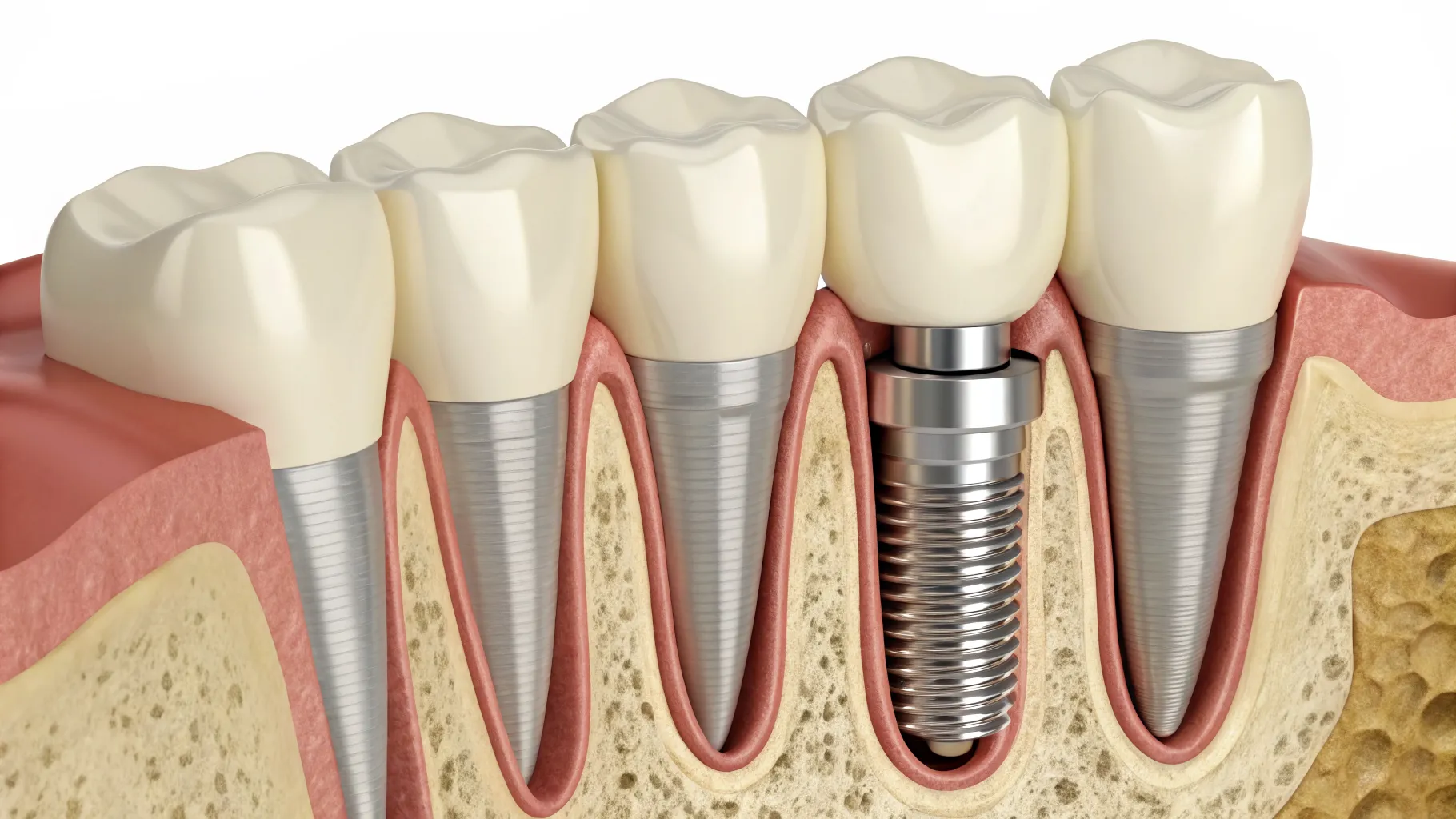 Understanding Modern Dental Implant Costs in the United States: A Comprehensive Guide