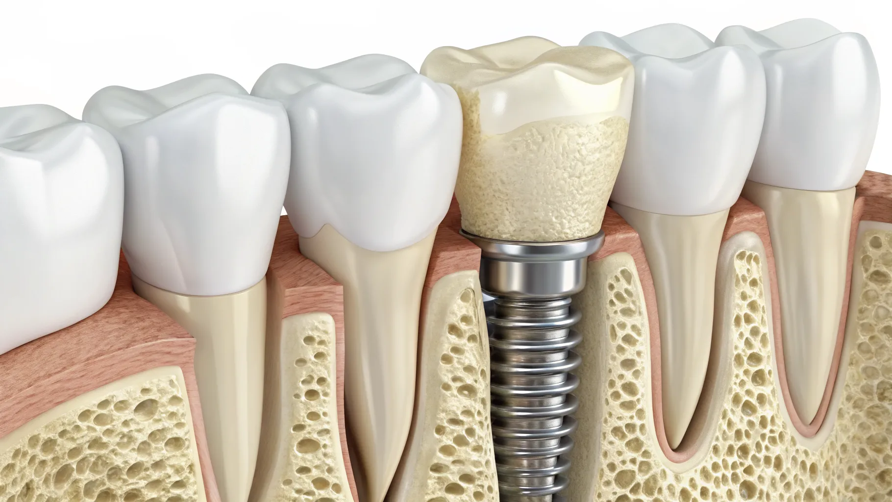 Implantes dentales sin tornillos: Ventajas, Desventajas y la Odontología Moderna