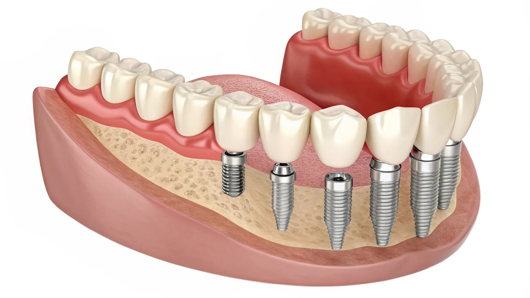 The Dental Implant Option More Adults Are Exploring Today